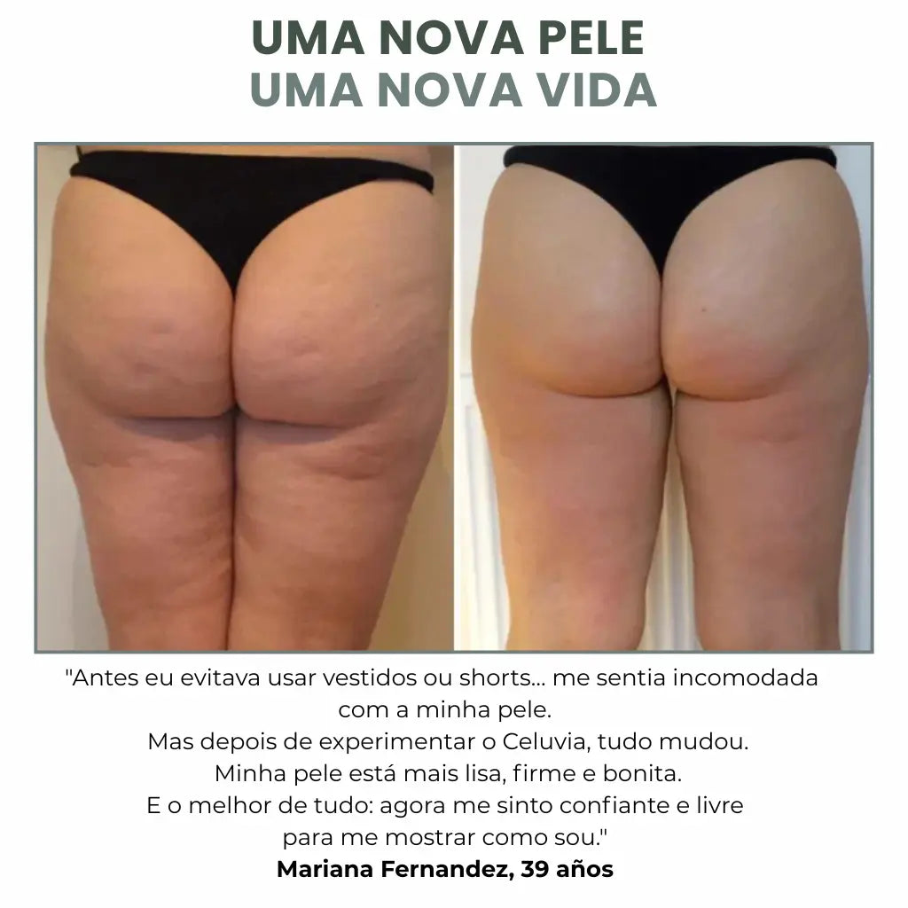 Celuvia™ Masajeador Anticelulítico