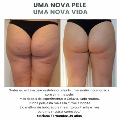 Celuvia™ Masajeador Anticelulítico