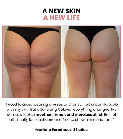 Celuvia™ Anti-Cellulite Massage Kit